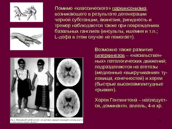 Помимо «классического» паркинсонизма, возникающего в результате дегенерации черной субстанции, акинезия, ригидность и тремор наблюдаются