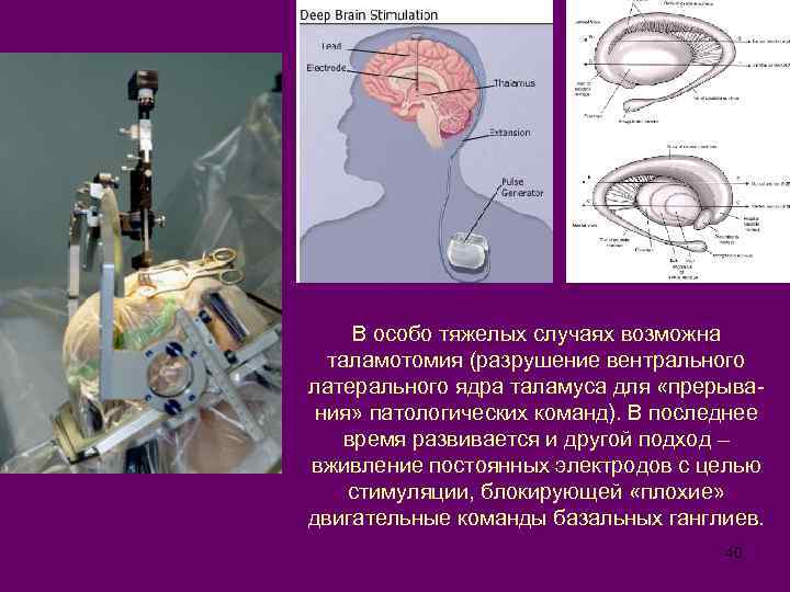 В особо тяжелых случаях возможна таламотомия (разрушение вентрального латерального ядра таламуса для «прерывания» патологических