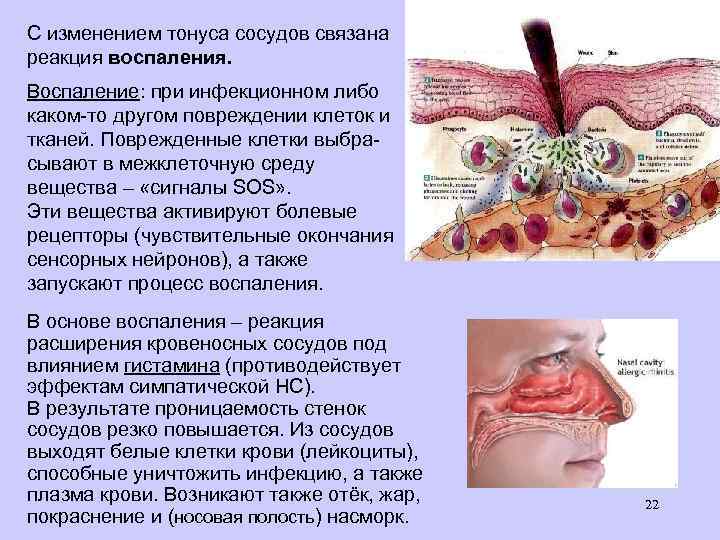 С изменением тонуса сосудов связана реакция воспаления. Воспаление: при инфекционном либо каком-то другом повреждении