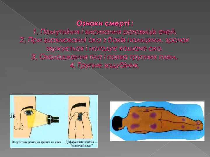 Ознаки смерті : 1. Помутніння і висихання роговиців очей. 2. При здавлюванні ока з