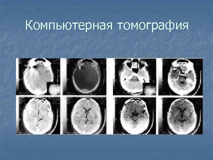 Компьютерная томография 