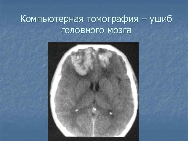 Компьютерная томография – ушиб головного мозга 