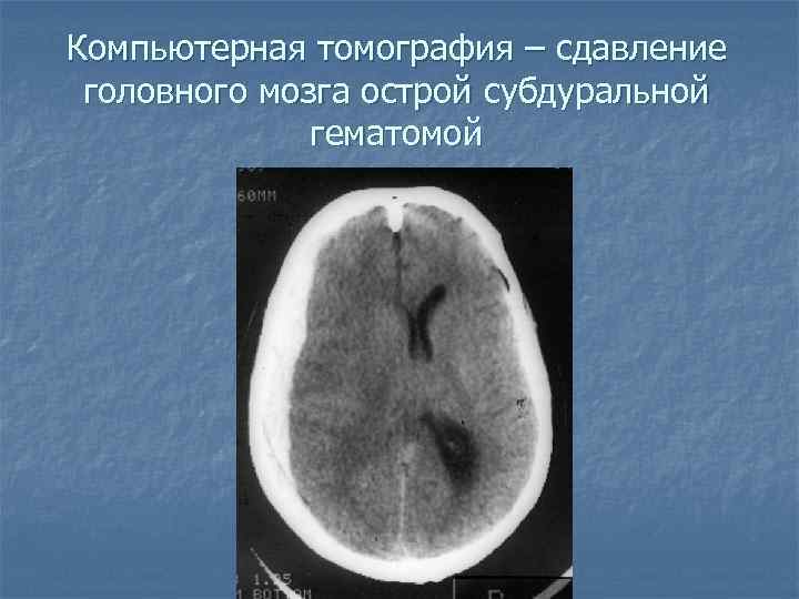 Компьютерная томография – сдавление головного мозга острой субдуральной гематомой 