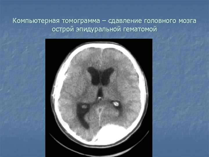 Компьютерная томограмма – сдавление головного мозга острой эпидуральной гематомой 