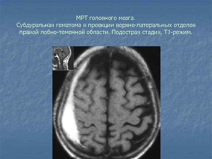 МРТ головного мозга. Субдуральная гематома в проекции верхне-латеральных отделов правой лобно-теменной области. Подострая стадия,