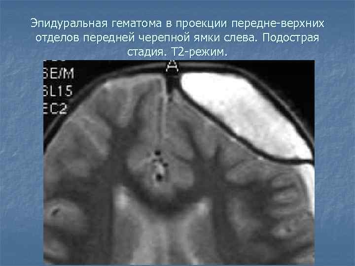 Эпидуральная гематома в проекции передне-верхних отделов передней черепной ямки слева. Подострая стадия. Т 2