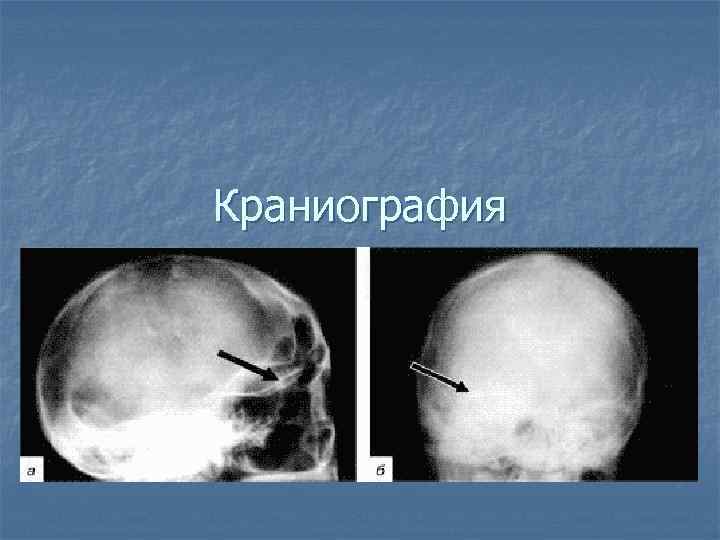 Краниография 