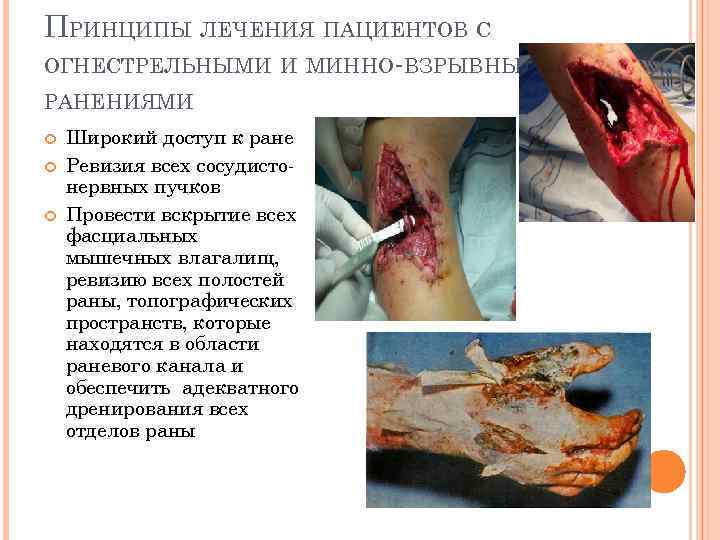 ПРИНЦИПЫ ЛЕЧЕНИЯ ПАЦИЕНТОВ С ОГНЕСТРЕЛЬНЫМИ И МИННО-ВЗРЫВНЫМИ РАНЕНИЯМИ Широкий доступ к ране Ревизия всех