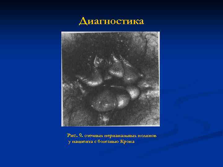 Диагностика Рис. 9. отечных перианальных полипов у пациента с болезнью Крона 