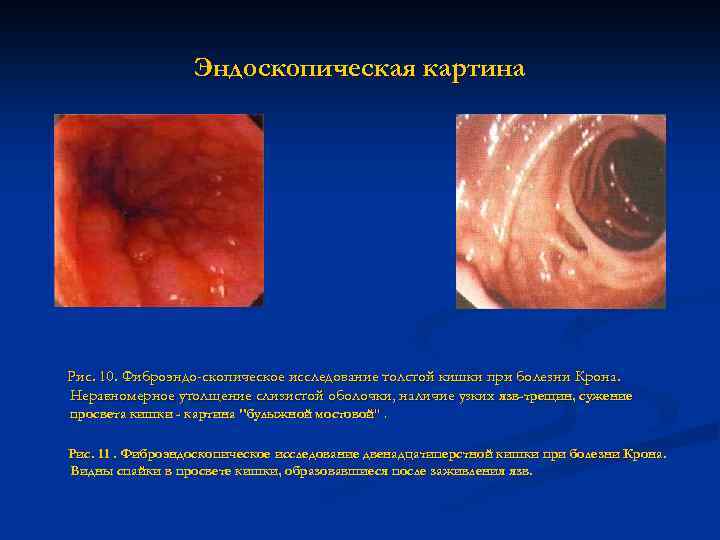 Эндоскопическая картина Рис. 10. Фиброэндо-скопическое исследование толстой кишки при болезни Крона. Неравномерное утолщение слизистой