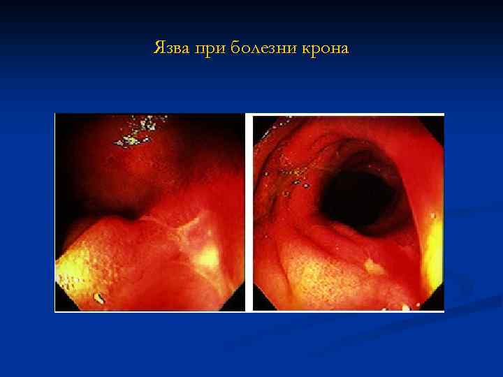Язва при болезни крона 