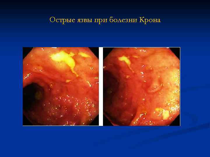 Острые язвы при болезни Крона 