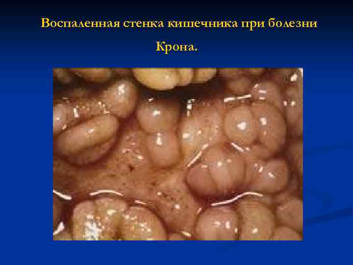 Воспаленная стенка кишечника при болезни Крона. 