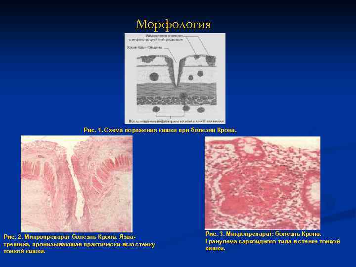 Морфология Рис. 1. Схема поражения кишки при болезни Крона. Рис. 2. Микропрепарат болезнь Крона.