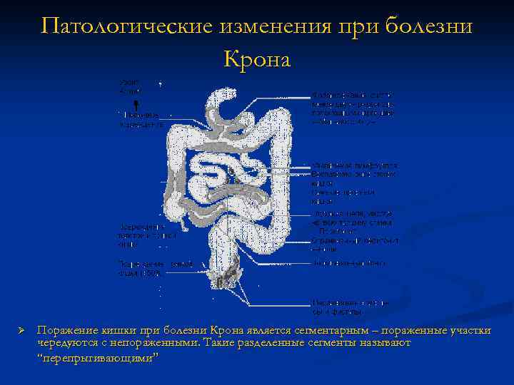 Патологические изменения при болезни Крона Ø Поражение кишки при болезни Крона является сегментарным –