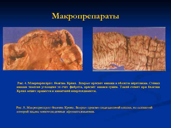 Макропрепараты Рис. 4. Макропрепарат: болезнь Крона. Вскрыт просвет кишки в области перетяжки. Стенка кишки