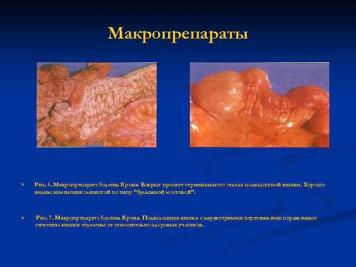 Макропрепараты Ø Рис. 6. Макропрепарат: болезнь Крона. Вскрыт просвет терминального отдела подвздошной кишки. Хорошо
