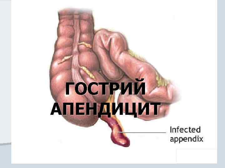 ГОСТРИЙ АПЕНДИЦИТ 