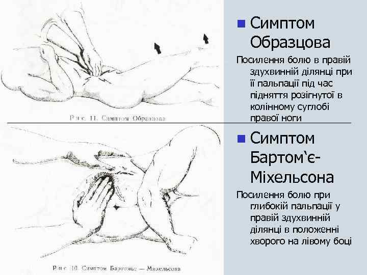 n Симптом Образцова Посилення болю в правій здухвинній ділянці при її пальпації під час