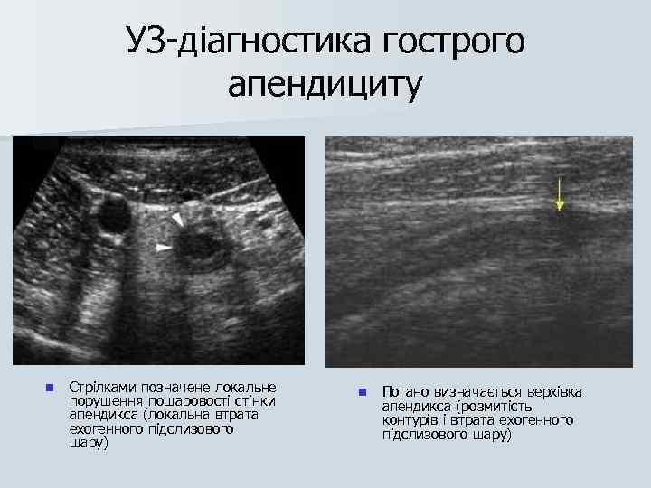 УЗ-діагностика гострого апендициту n Стрілками позначене локальне порушення пошаровості стінки апендикса (локальна втрата ехогенного