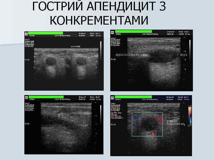 ГОСТРИЙ АПЕНДИЦИТ З КОНКРЕМЕНТАМИ 