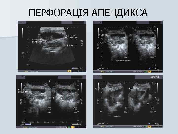 ПЕРФОРАЦІЯ АПЕНДИКСА 