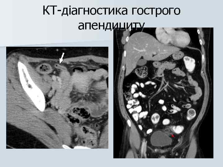КТ-діагностика гострого апендициту 