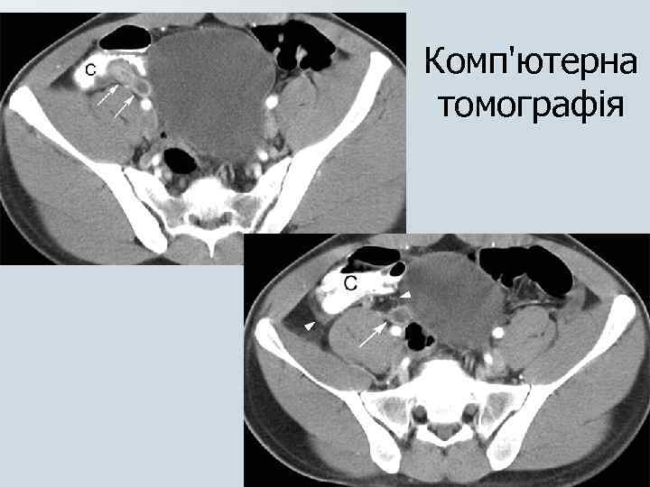 Комп'ютерна томографія 