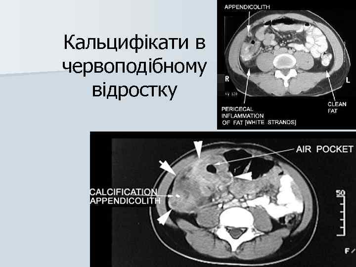Кальцифікати в червоподібному відростку 