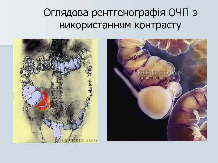 Оглядова рентгенографія ОЧП з використанням контрасту 