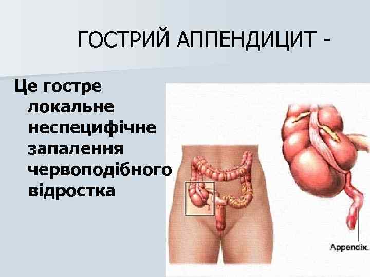 ГОСТРИЙ АППЕНДИЦИТ Це гостре локальне неспецифічне запалення червоподібного відростка 