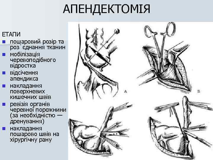 Удаление Аппендицита Цена