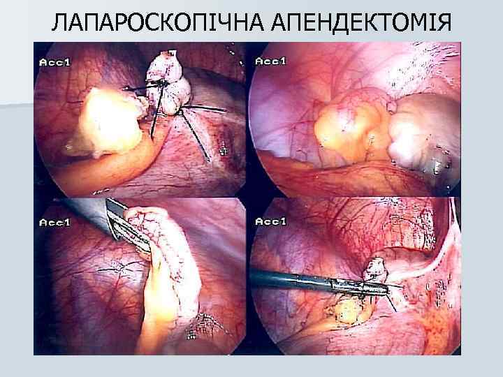 ЛАПАРОСКОПІЧНА АПЕНДЕКТОМІЯ 