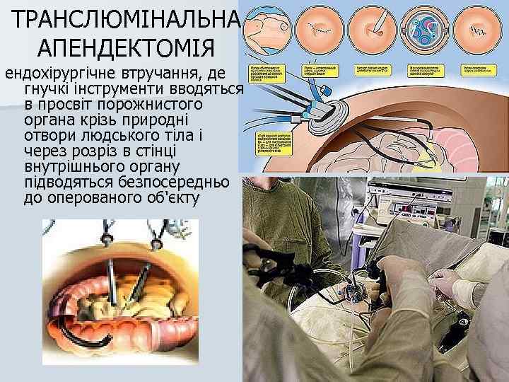 ТРАНСЛЮМІНАЛЬНА АПЕНДЕКТОМІЯ ендохірургічне втручання, де гнучкі інструменти вводяться в просвіт порожнистого органа крізь природні