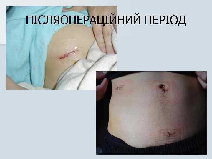 ПІСЛЯОПЕРАЦІЙНИЙ ПЕРІОД 