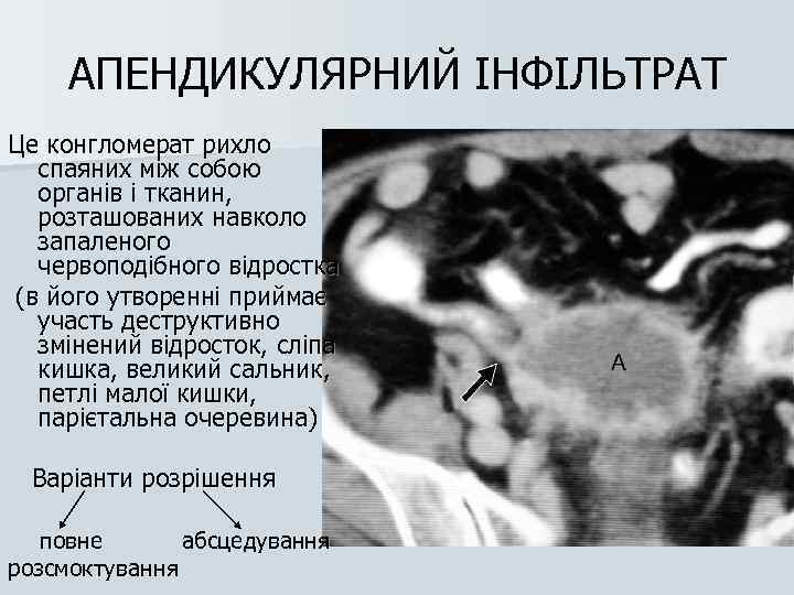 АПЕНДИКУЛЯРНИЙ ІНФІЛЬТРАТ Це конгломерат рихло спаяних між собою органів і тканин, розташованих навколо запаленого
