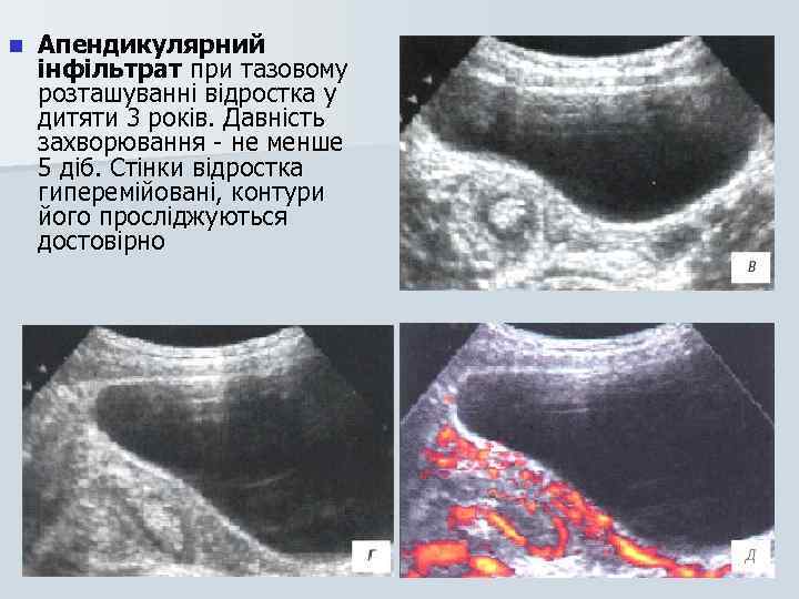 n Апендикулярний інфільтрат при тазовому розташуванні відростка у дитяти 3 років. Давність захворювання -
