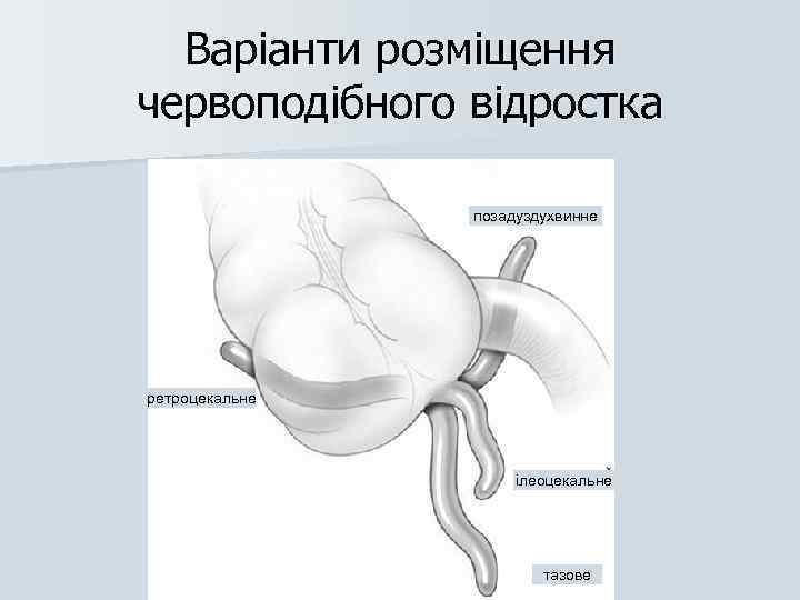 Варіанти розміщення червоподібного відростка позадуздухвинне ретроцекальне ілеоцекальне тазове 