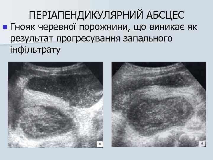 ПЕРІАПЕНДИКУЛЯРНИЙ АБСЦЕС n Гнояк черевної порожнини, що виникає як результат прогресування запального інфільтрату 