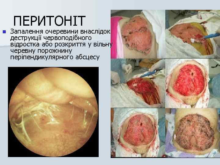 n ПЕРИТОНІТ Запалення очеревини внаслідок деструкції червоподібного відростка або розкриття у вільну черевну порожнину