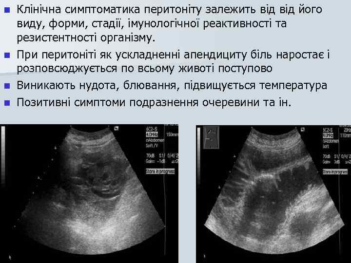 n n Клінічна симптоматика перитоніту залежить від його виду, форми, стадії, імунологічної реактивності та