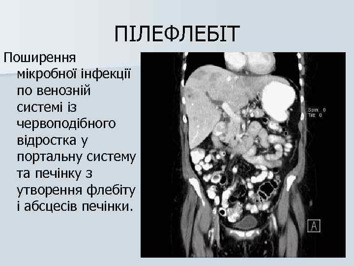 ПІЛЕФЛЕБІТ Поширення мікробної інфекції по венозній системі із червоподібного відростка у портальну систему та