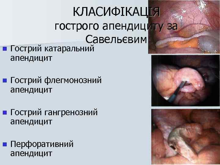 КЛАСИФІКАЦІЯ гострого апендициту за Савельєвим n Гострий катаральний апендицит n Гострий флегмонозний апендицит n