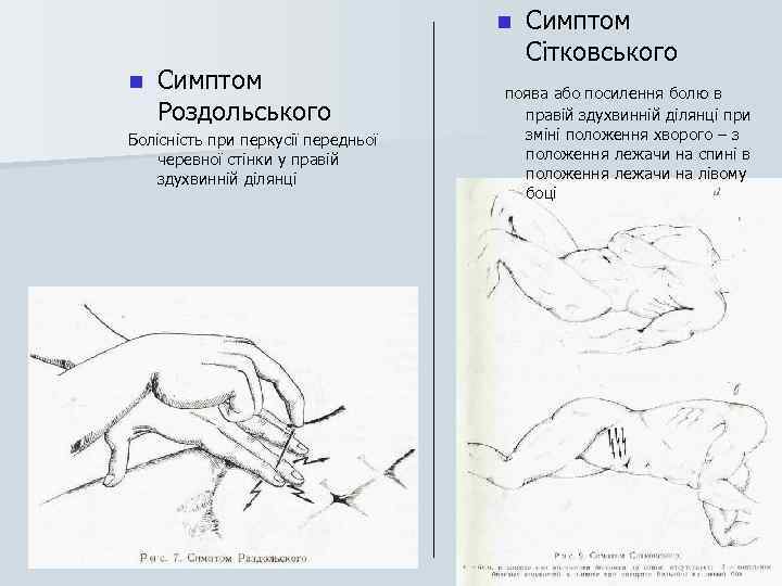 n n Симптом Роздольського Болісність при перкусії передньої черевної стінки у правій здухвинній ділянці