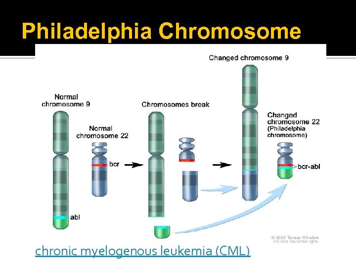 Philadelphia Chromosome chronic myelogenous leukemia (CML) 
