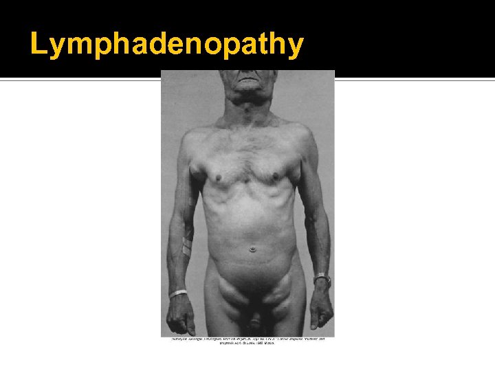 Lymphadenopathy 