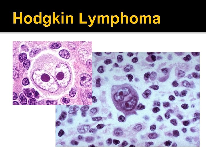 Hodgkin Lymphoma 