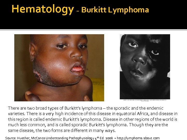 Hematology – Burkitt Lymphoma There are two broad types of Burkitt’s lymphoma – the