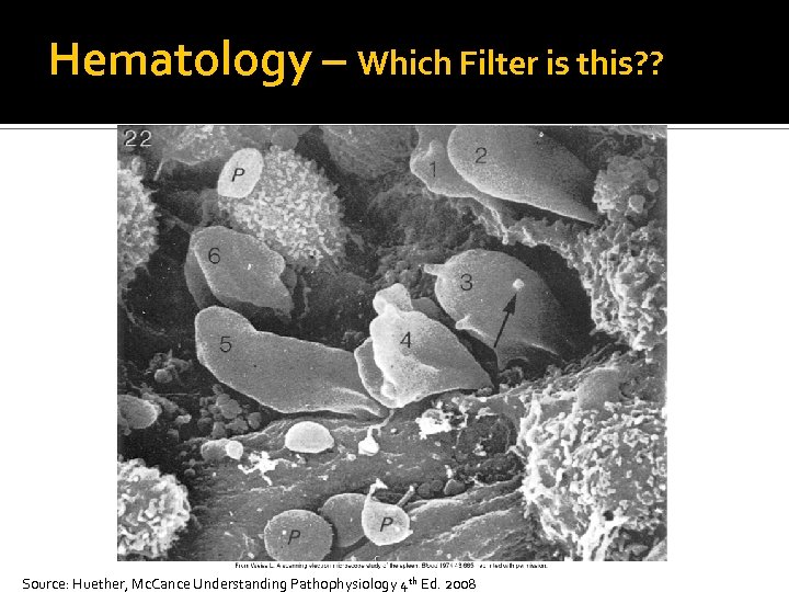 Hematology – Which Filter is this? ? Source: Huether, Mc. Cance Understanding Pathophysiology 4