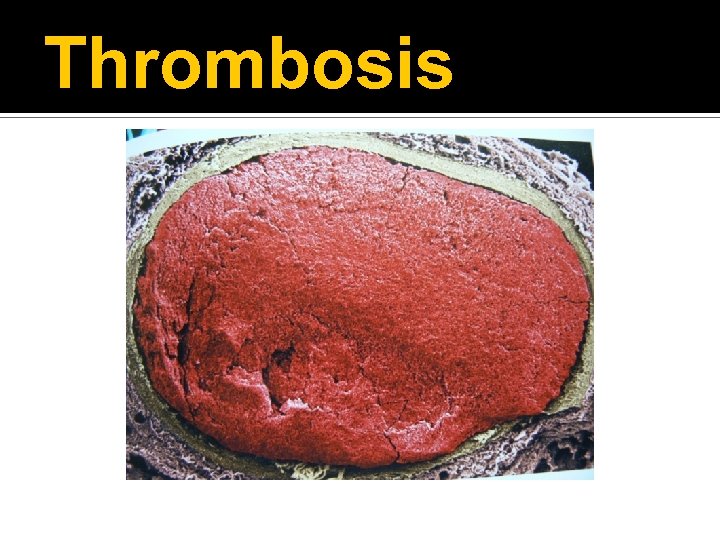 Thrombosis 